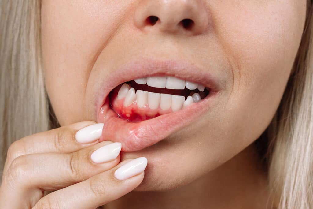 Bleeding Gums After Brushing: Should You Be Concerned?