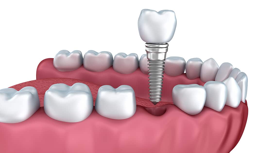 Single dental implant image