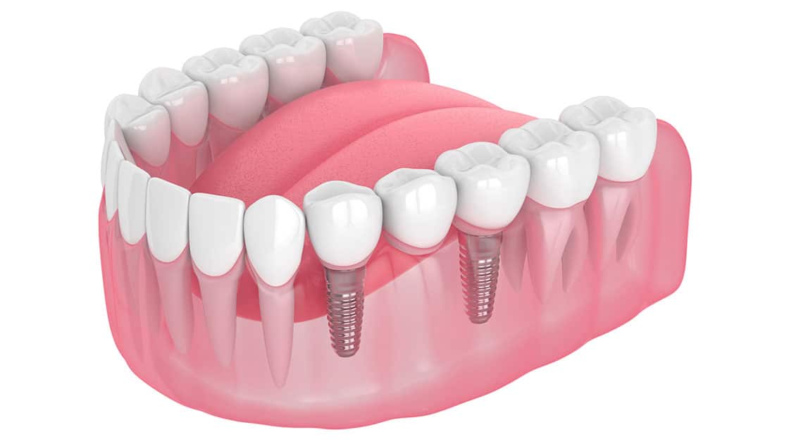 Dental implant bridge image