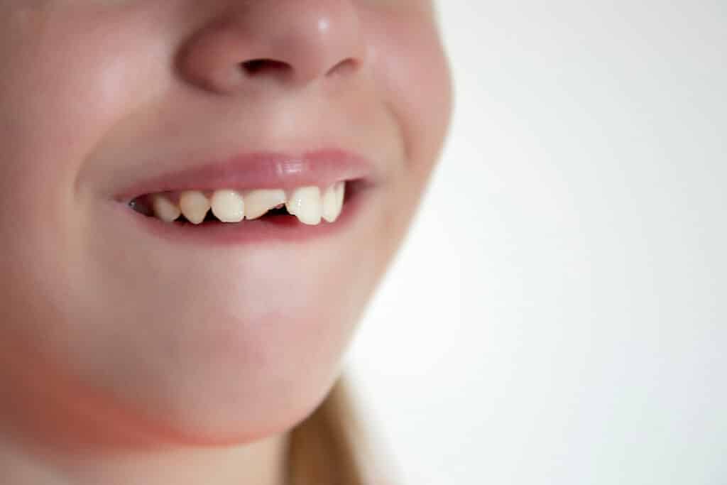 Knocked-Out Tooth? Here’s What to Do Before You Get to the Dentist
