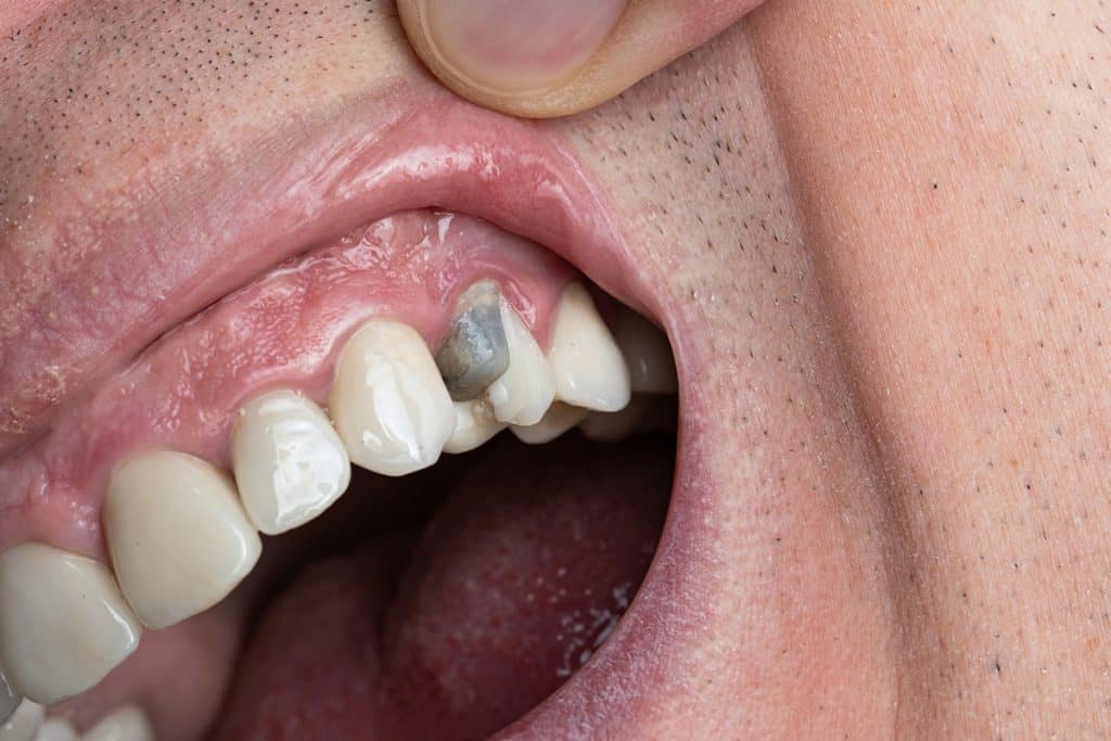 Temporary Crown Fell Off – What Should You Do?